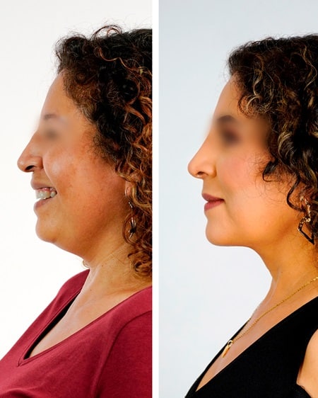 lifting facial deep plane