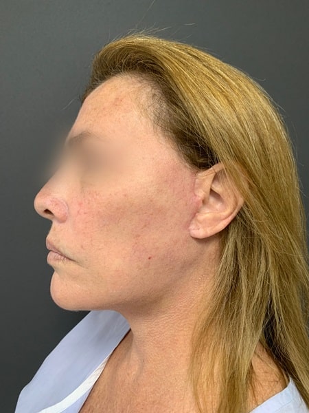 deep plane facelift after