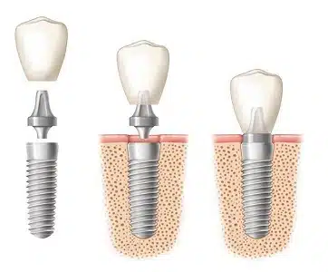 dental-image-3 stages multiple dental implants