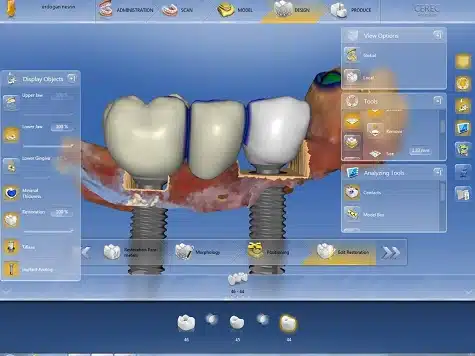 implantes dentales y la tecnología