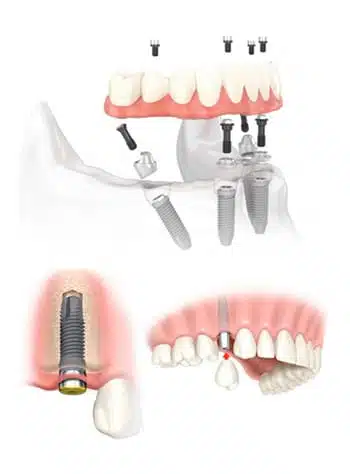 dental-rehabilitation-reconstruction2