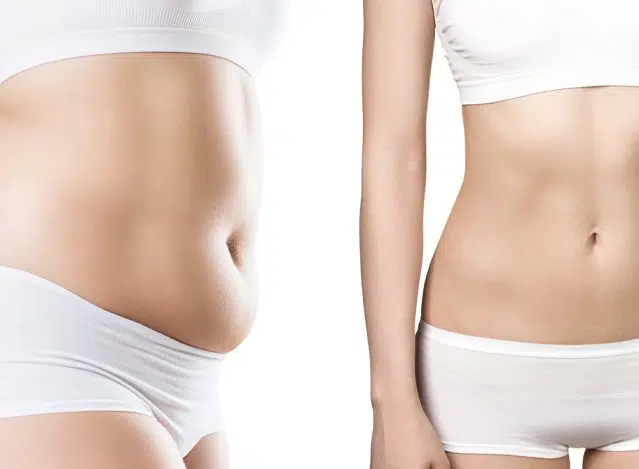 dermolipectomy lima