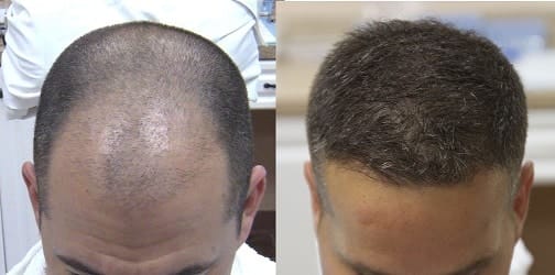 dhi hair transplants lima