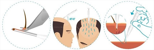 direct hair implantation dhi