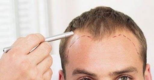 dhi hair transplants