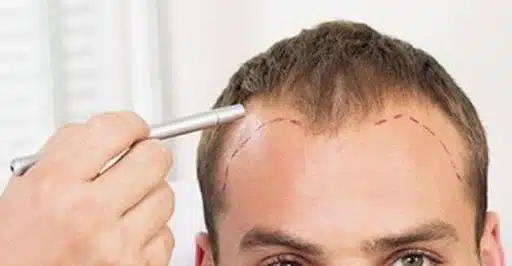 dhi hair transplants