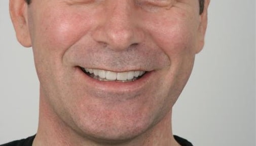 full mouth reconstruction