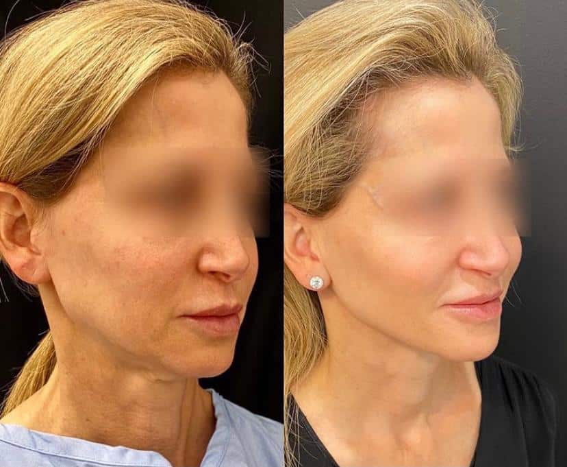 facelift y neck lift combo