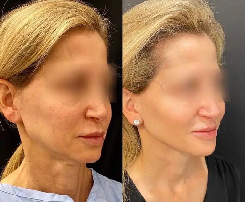 facelift y neck lift combo