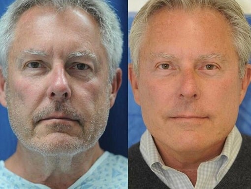 facelift in lima peru