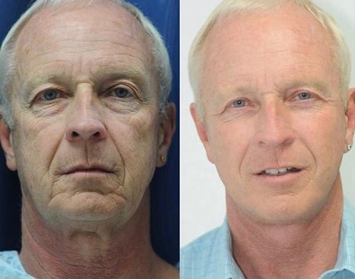 facelift in lima peru