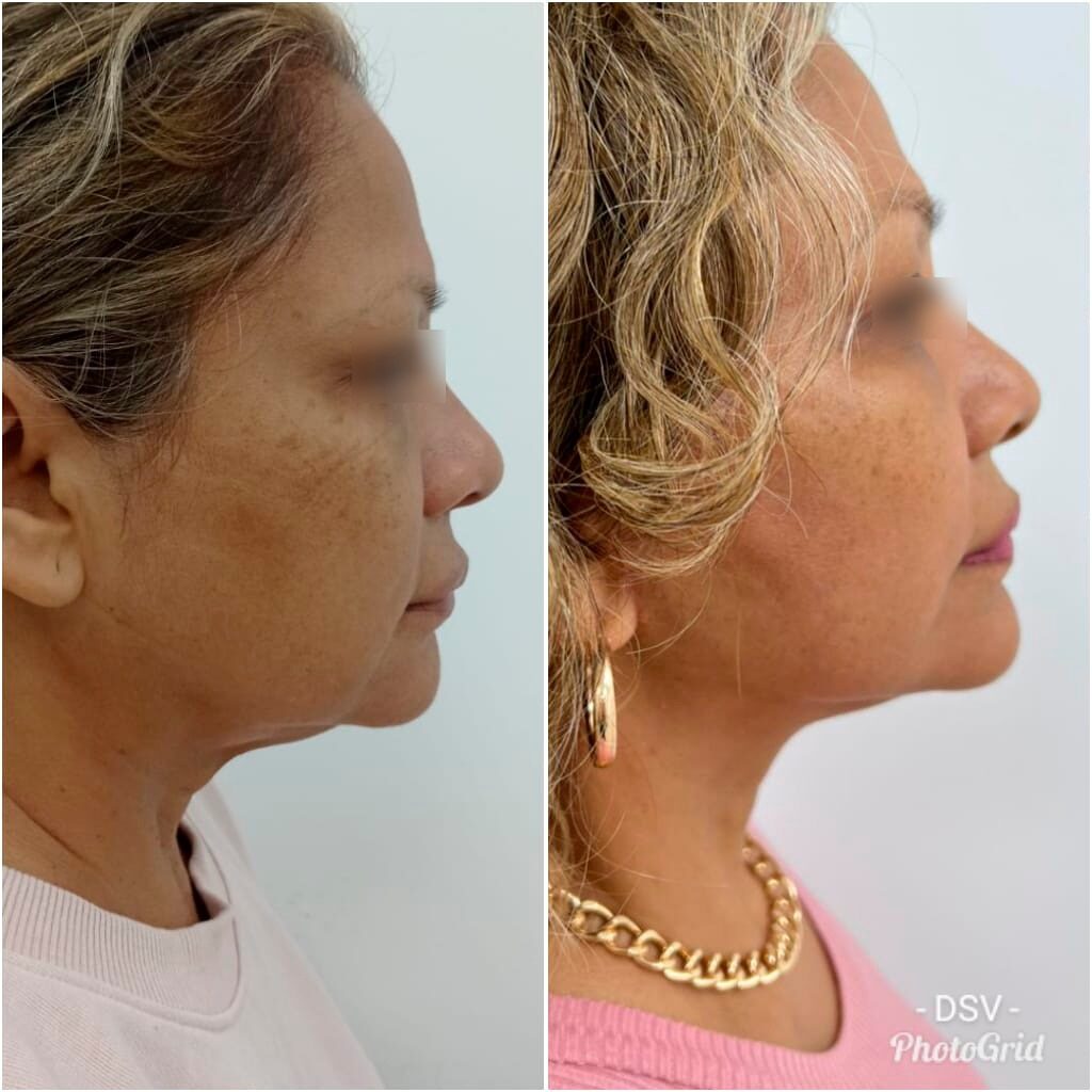facelift neck lift combo