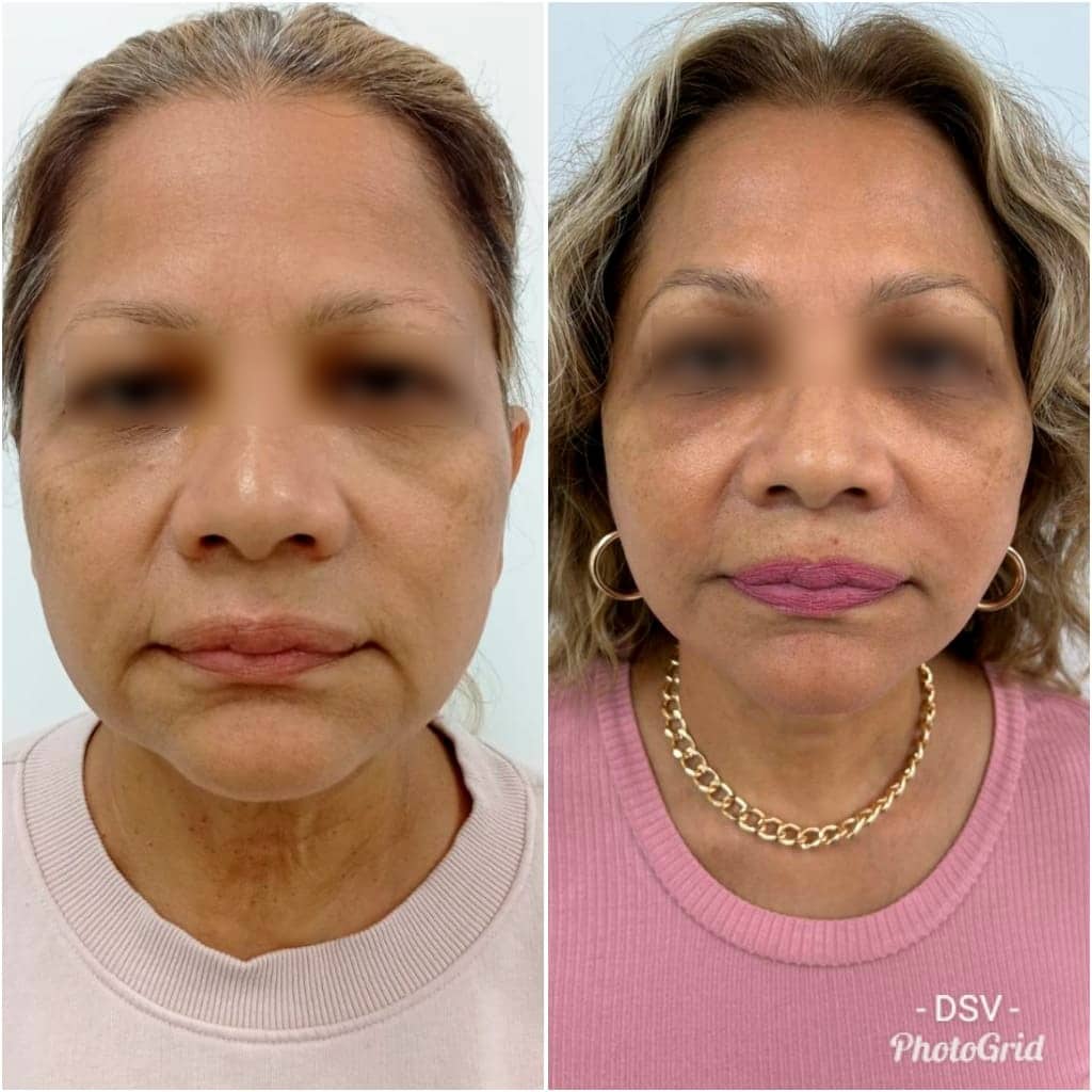 lifting facial