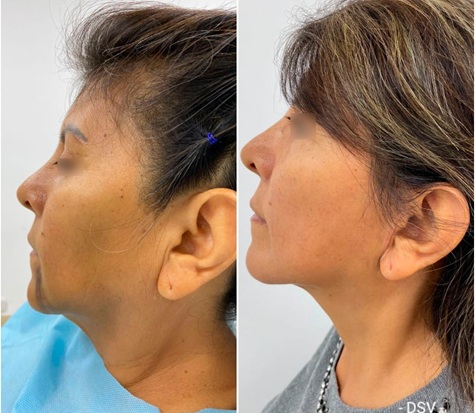 facelift neck lift combo lima peru
