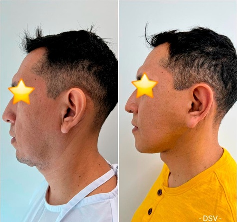 facelift neck lift combo male