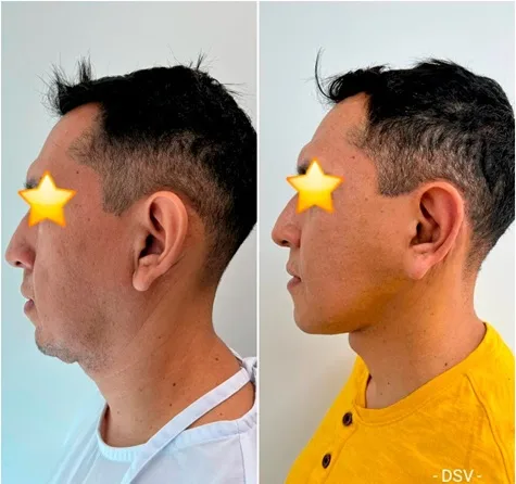 Facelift and Neck Lift Lima Peru