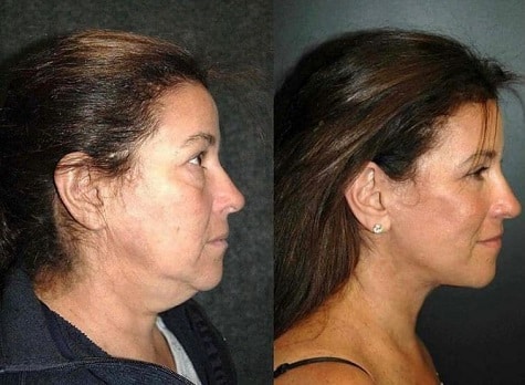 facial surgeries