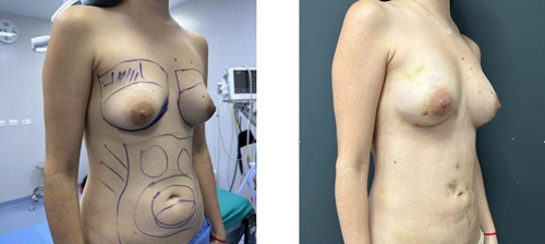 breast augmentation fat transfer