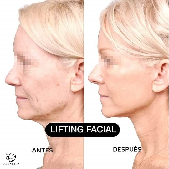 cirugía plástica en Lima, Peru lifting facial
