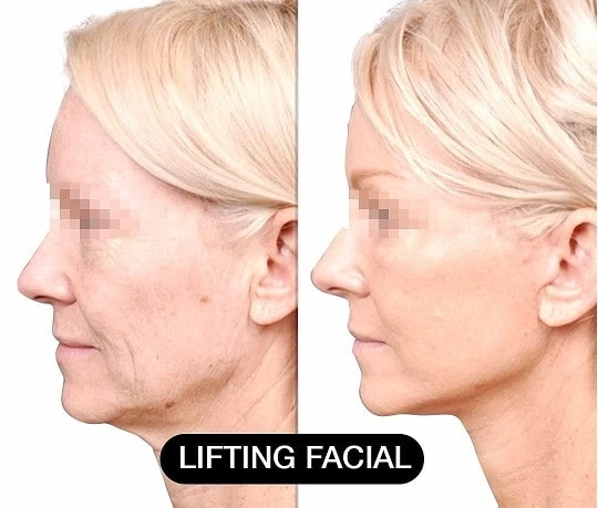 facelift in lima peru