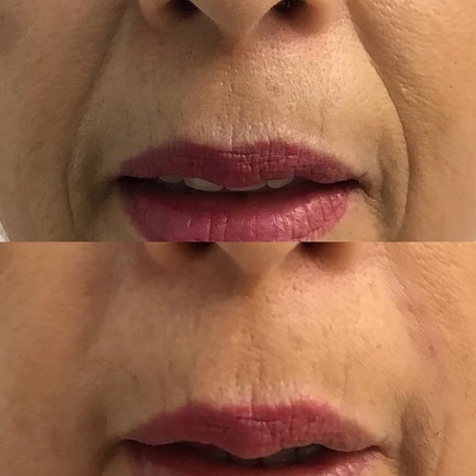 fillers