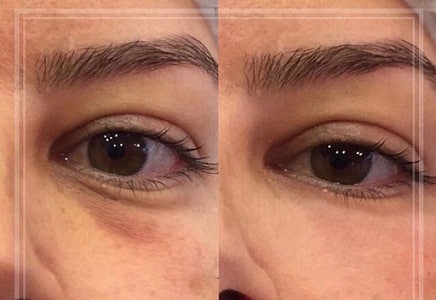 Hyaluronic acid
