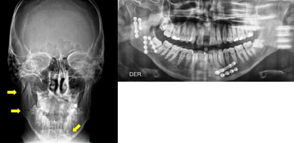 fractura condilar