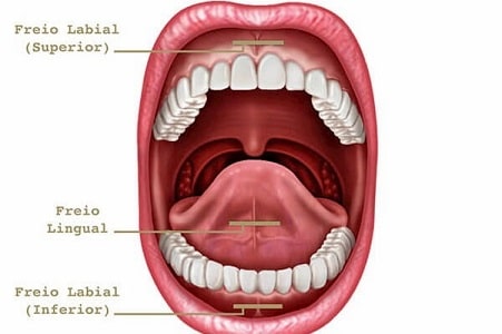 Frenectomy