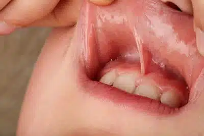 frenectomia lima peru Frenectomy