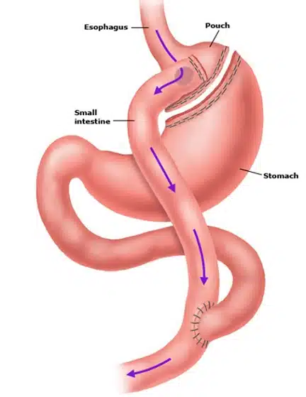 gastric bypass lima gastric bypass lima
