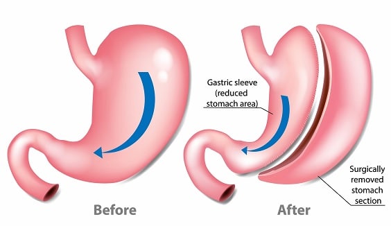 gastric sleeve