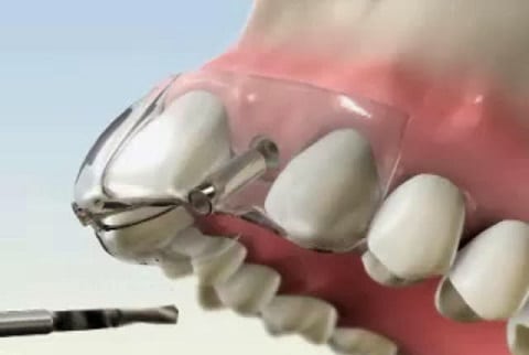 surgical guide