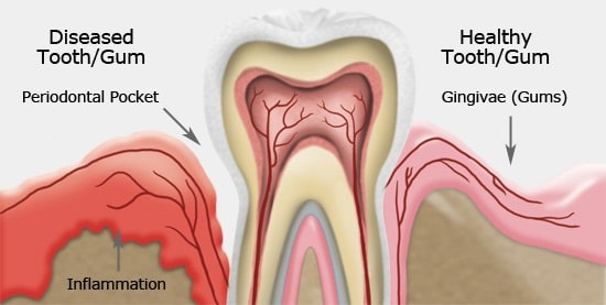 enfermedad periodontal