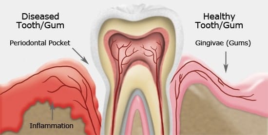 Periodontal Disease 