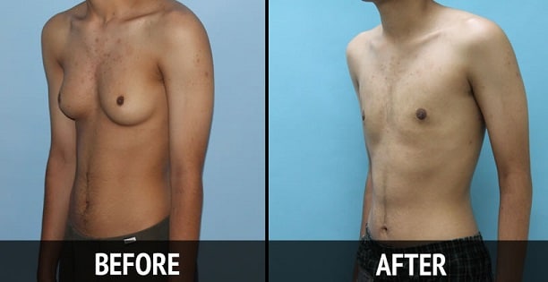 gynecomastia-surgery-lima 1