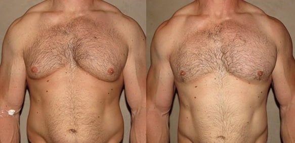 gynecomastia-surgery-lima