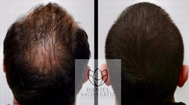 hair transplants lima