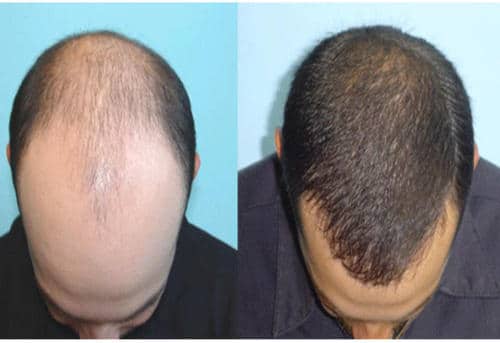 hair transplant lima