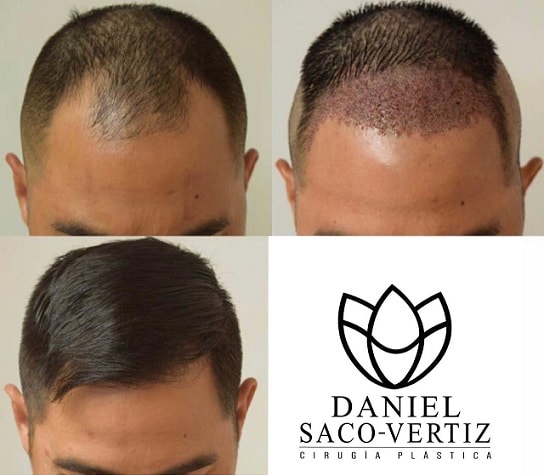 hair transplants in lima
