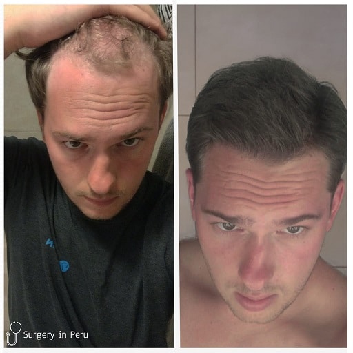 hair transplants lima peru