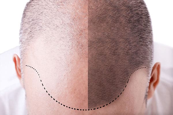 how many hair transplants