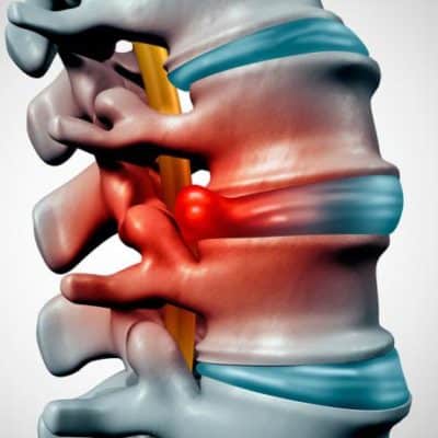 back hernia lima peru chiropractor