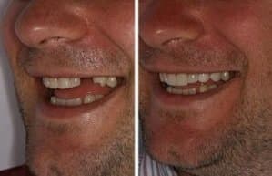 implantes dentales lima