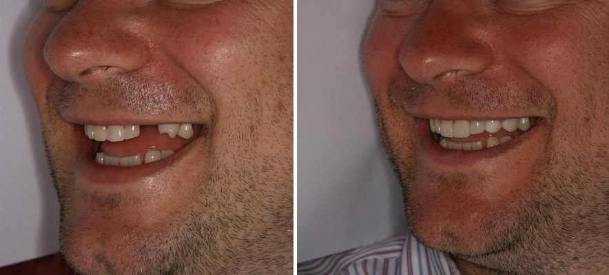 implantes dentales straumann en lima