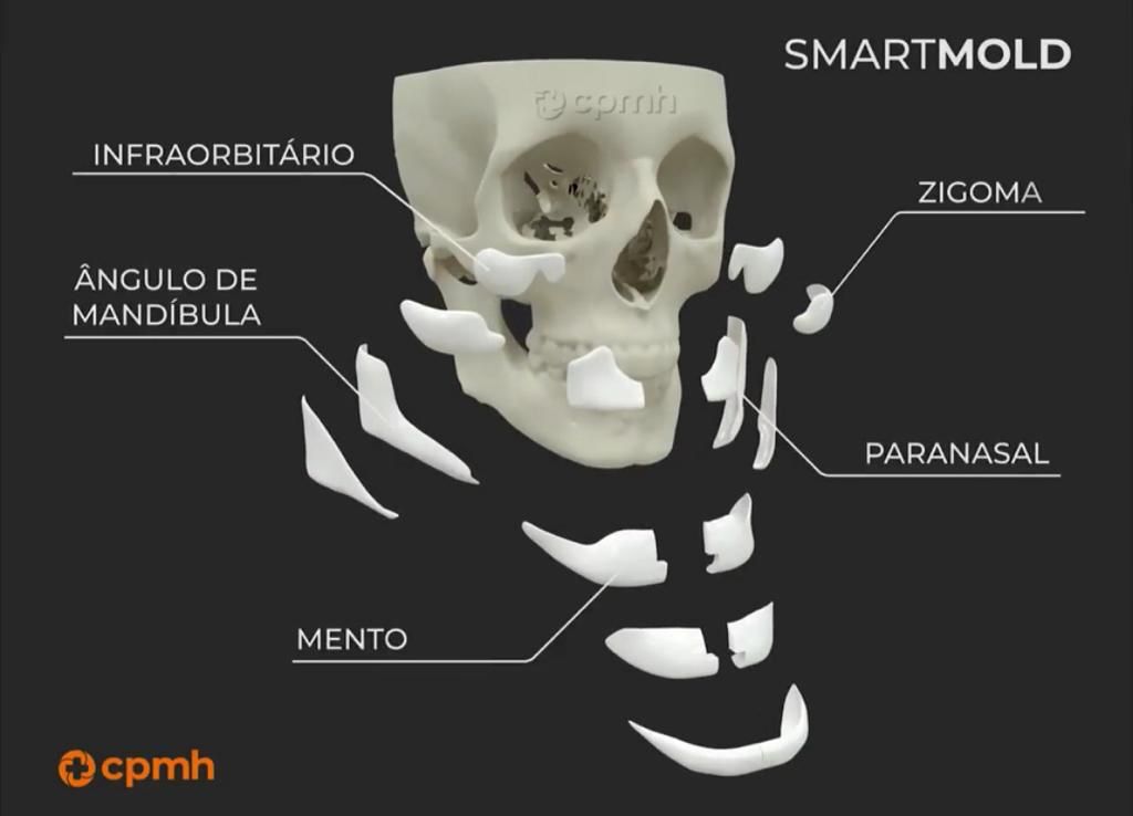 Mandibular Implants / Surgical Jaw Augmentation - Surgery in Peru