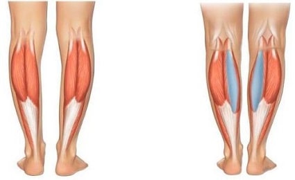 calf implants