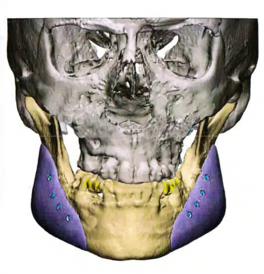 implantes-mandibular