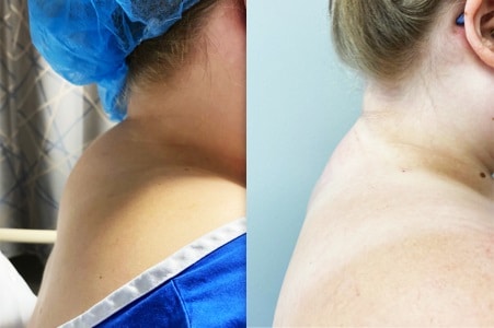 buffalo hump removal