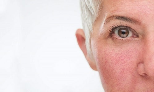 rosacea