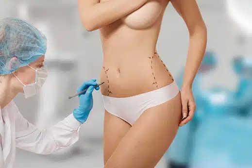 body lift